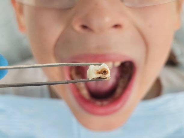 Best Emergency Treatment for Oral Infections in Vanceburg, KY